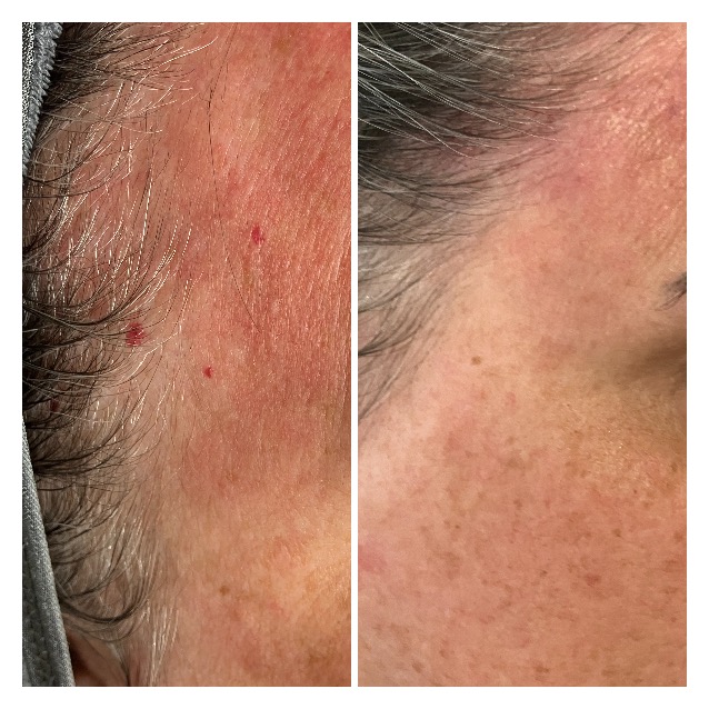 Before and after skin treatment result