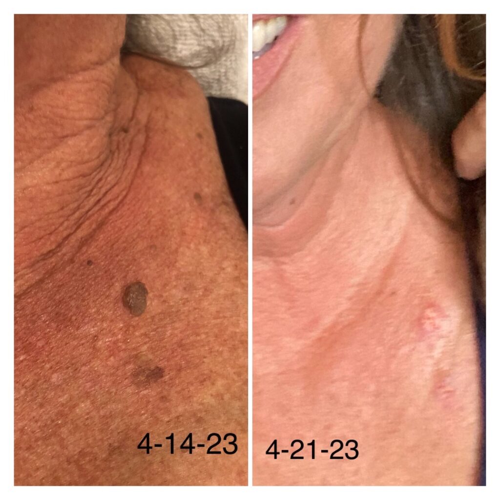 Before and after Skin Classic treatment result