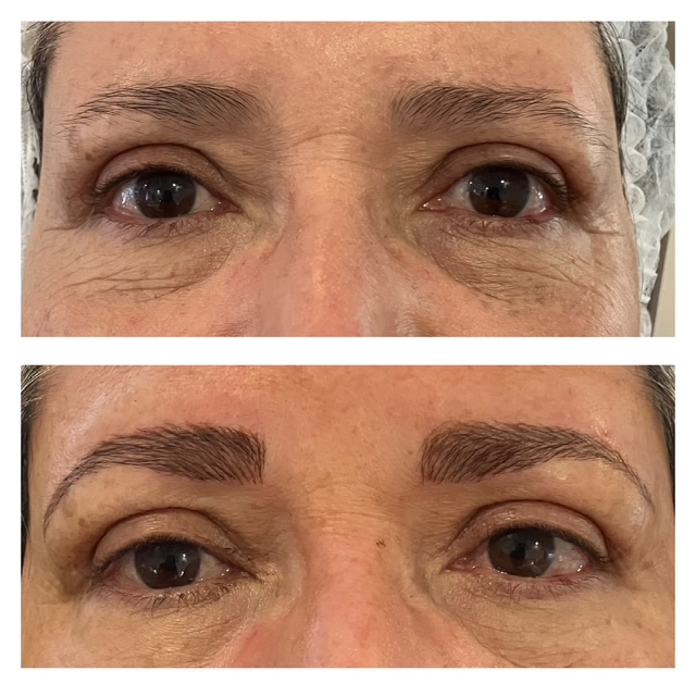 Before and after eyebrow treatment result